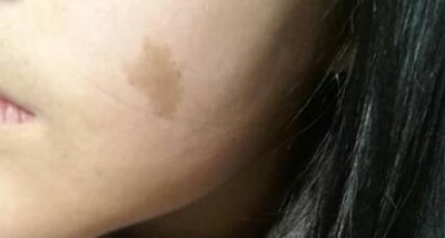 什么样的咖啡斑能淡掉？